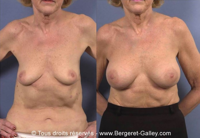 Breast augmentation with implants on an older lady