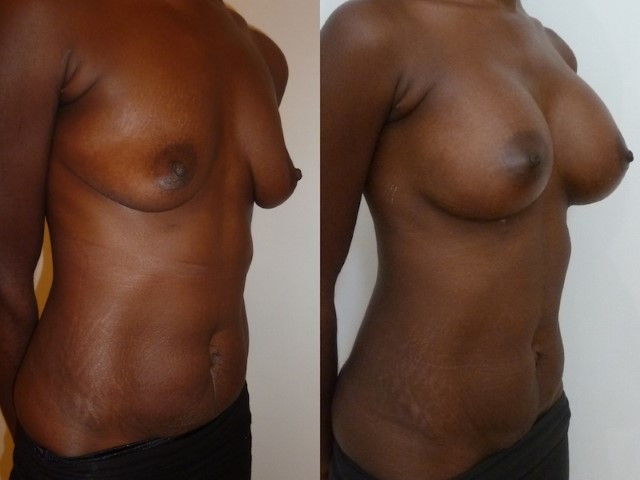 Photo before-and-after a breast augmentation with implants