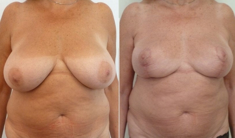 Breast reduction with URGOTOUCH