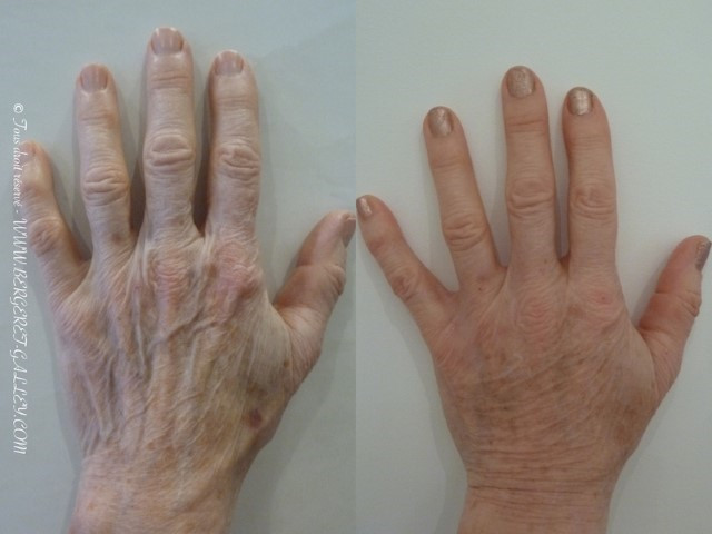 Résult of lipofilling hands