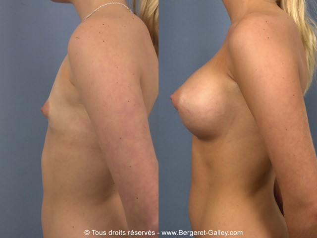 Photo from the side on the same patient showing an excellent result.