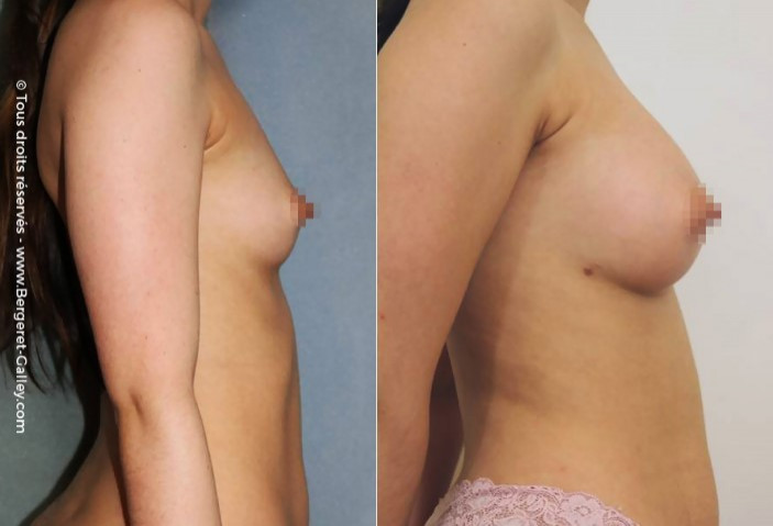 lipofilling breasts, Lipoaspiration and reinjection of fat