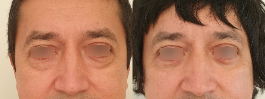 Result of blepharoplasty