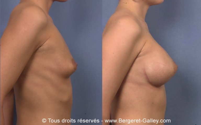 Breast augmentation paris, with implants behind the muscle, 350 mL each side