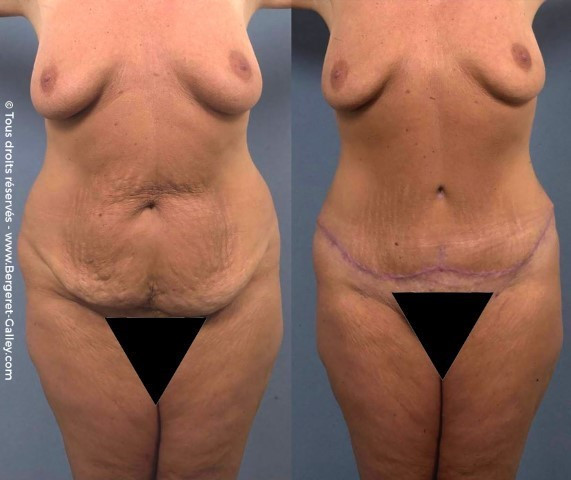 Tummy Tuck berfore/after