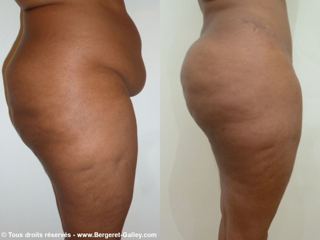 Buttocks augmentation with lipofilling