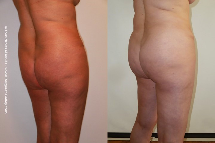 Abdominoplasty with Lipofilling of the buttocks  before/after