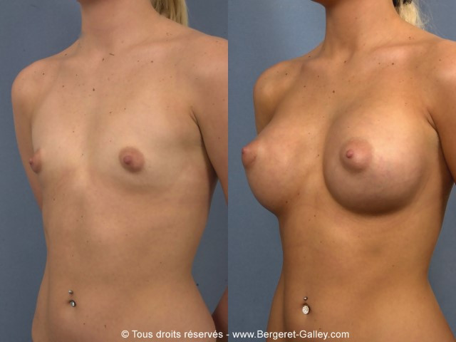 Breast augmentation with implants 320 ml