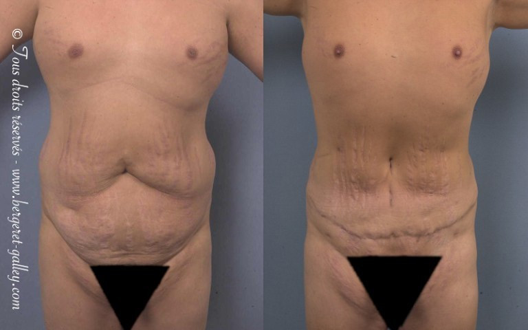 Before and after abdominoplasty on a man.