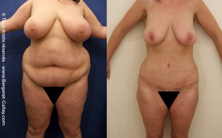Abdominoplasty and liposuction on a young woman after multiple pregnancies