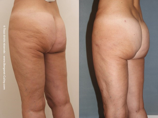 Buttock augmentation with buttocks Lipofilling instead of implants