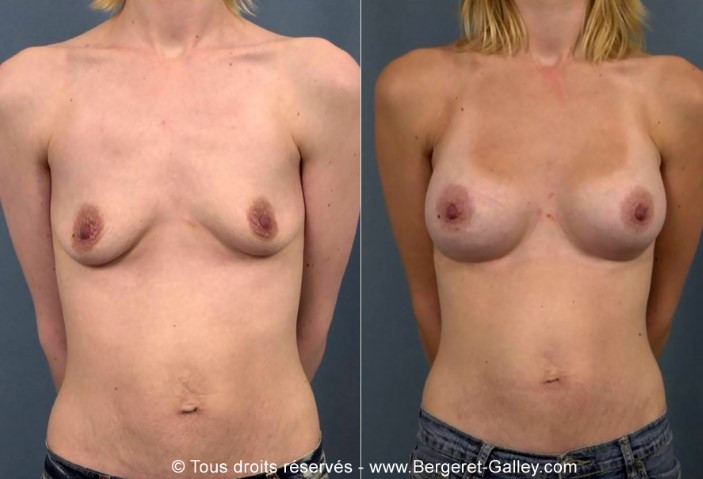 photo before and after a moderate breast augmentation  for ptosis