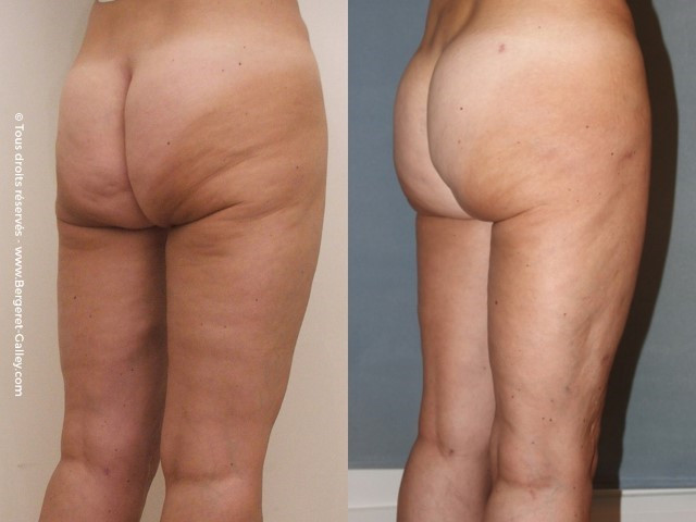 Before/After Buttocks augmentation