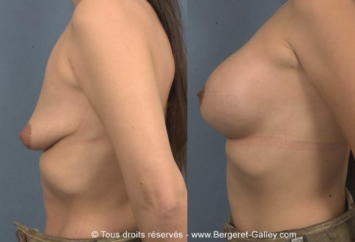 Photo before-and-after a breast enlargement with implants of 350mL