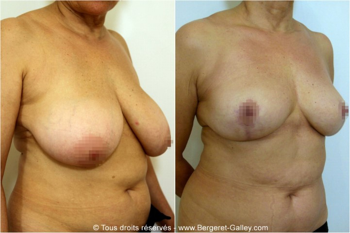 Breast reduction Paris