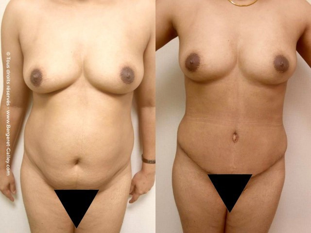 abdominal aesthetic surgery, before and after