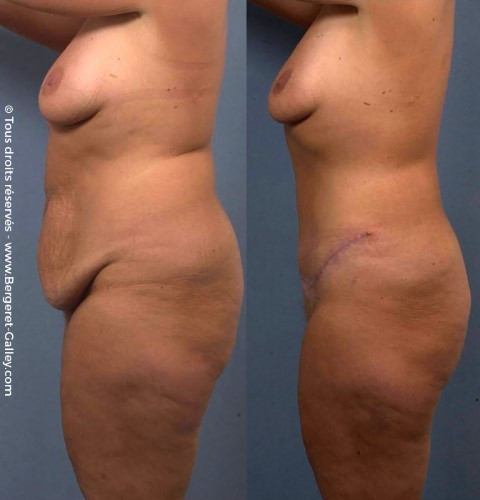 Abdominoplasty berfore/after