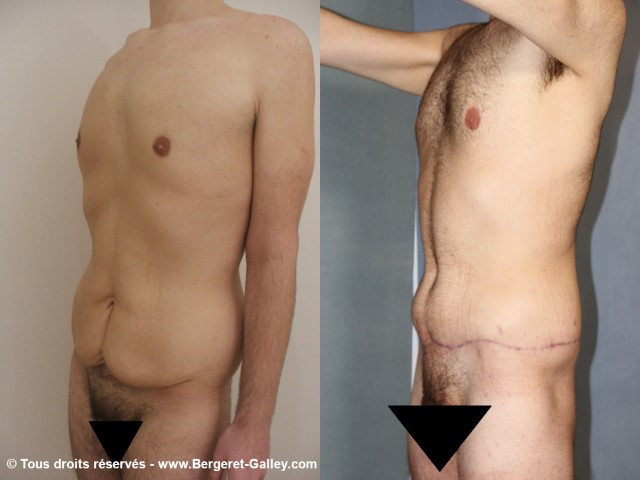 Before/After Bodylift  of a  man
