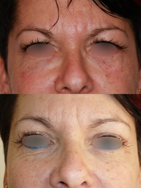 Result of blepharoplasty