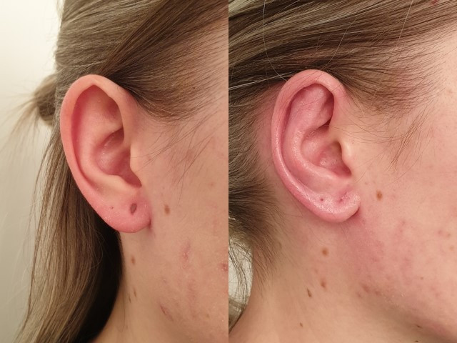 Otoplasty or Ears surgery
