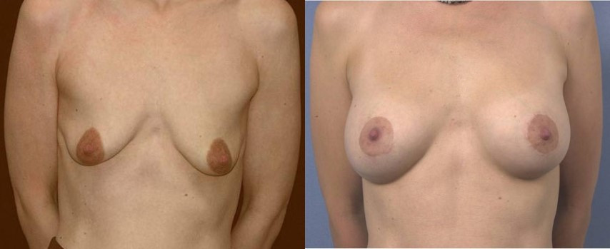 Result after mastopexy and breast implant