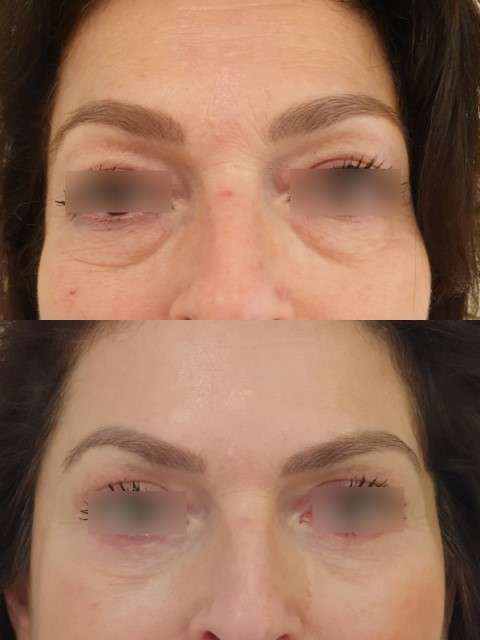 Result of blepharoplasty