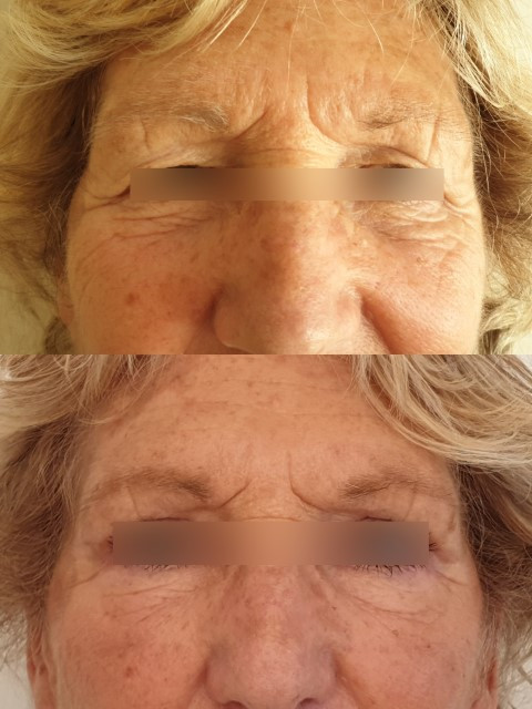 Result of blepharoplasty