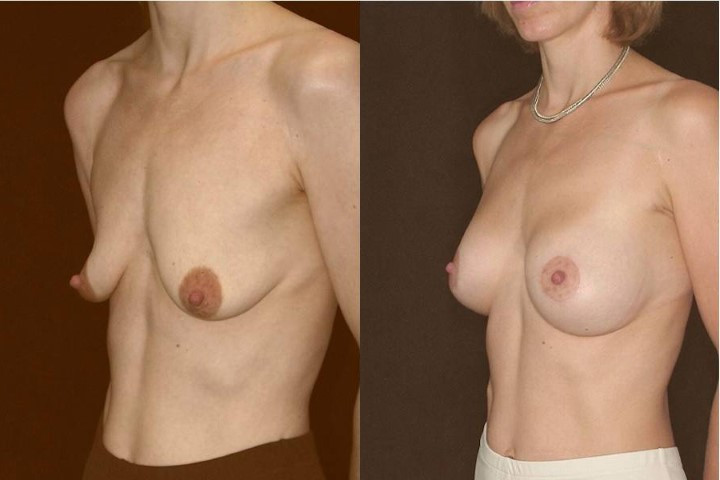 Before and after breast augmentation plus lifting