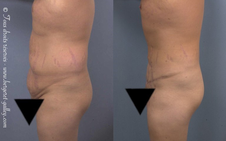 Abdominoplasty on a man in profil
